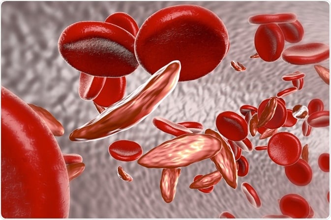 Sickle Cell anaemia